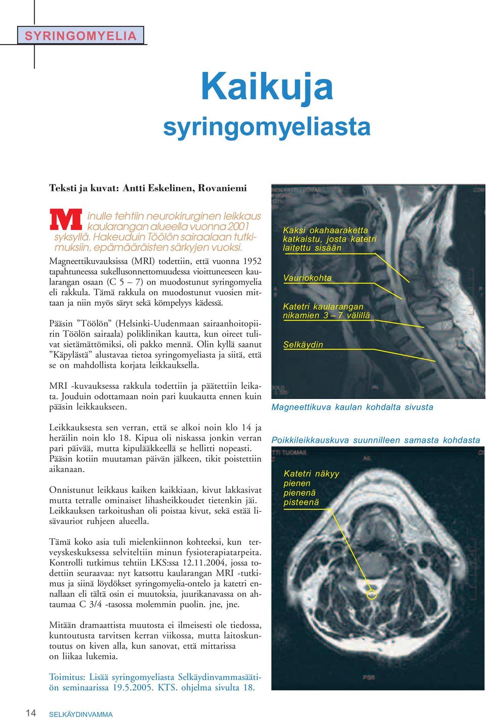 Magneettikuvauksissa (MRI) todettiin, että vuonna 1952 tapahtuneessa sukellusonnettomuudessa vioittuneeseen kaularangan osaan (C 5 7) on muodostunut syringomyelia eli rakkula.