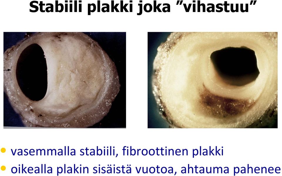 fibroottinen plakki oikealla