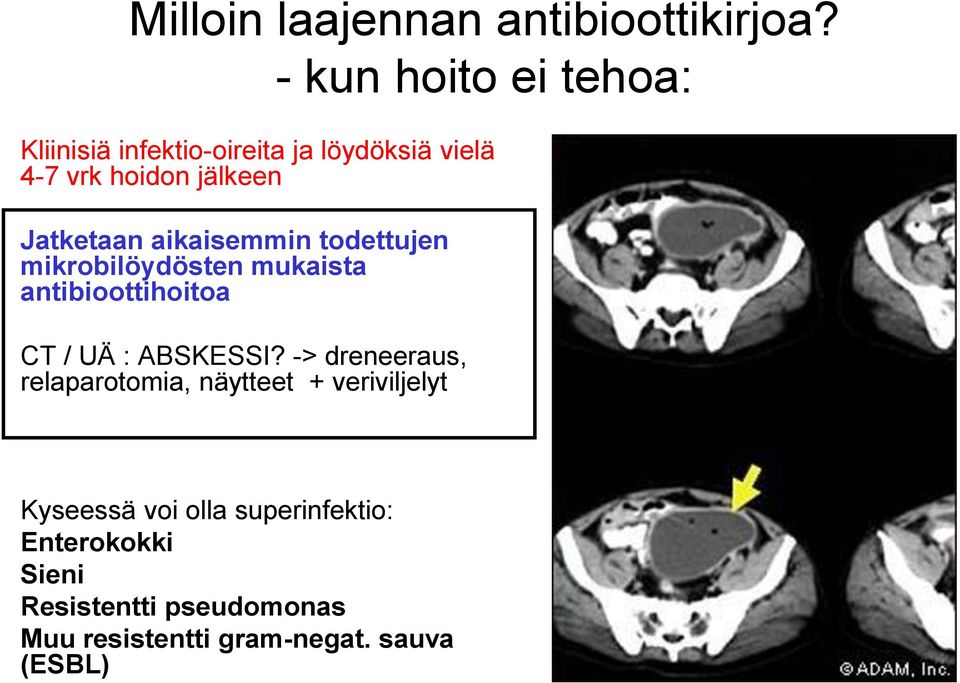 Jatketaan aikaisemmin todettujen mikrobilöydösten mukaista antibioottihoitoa CT / UÄ : ABSKESSI?