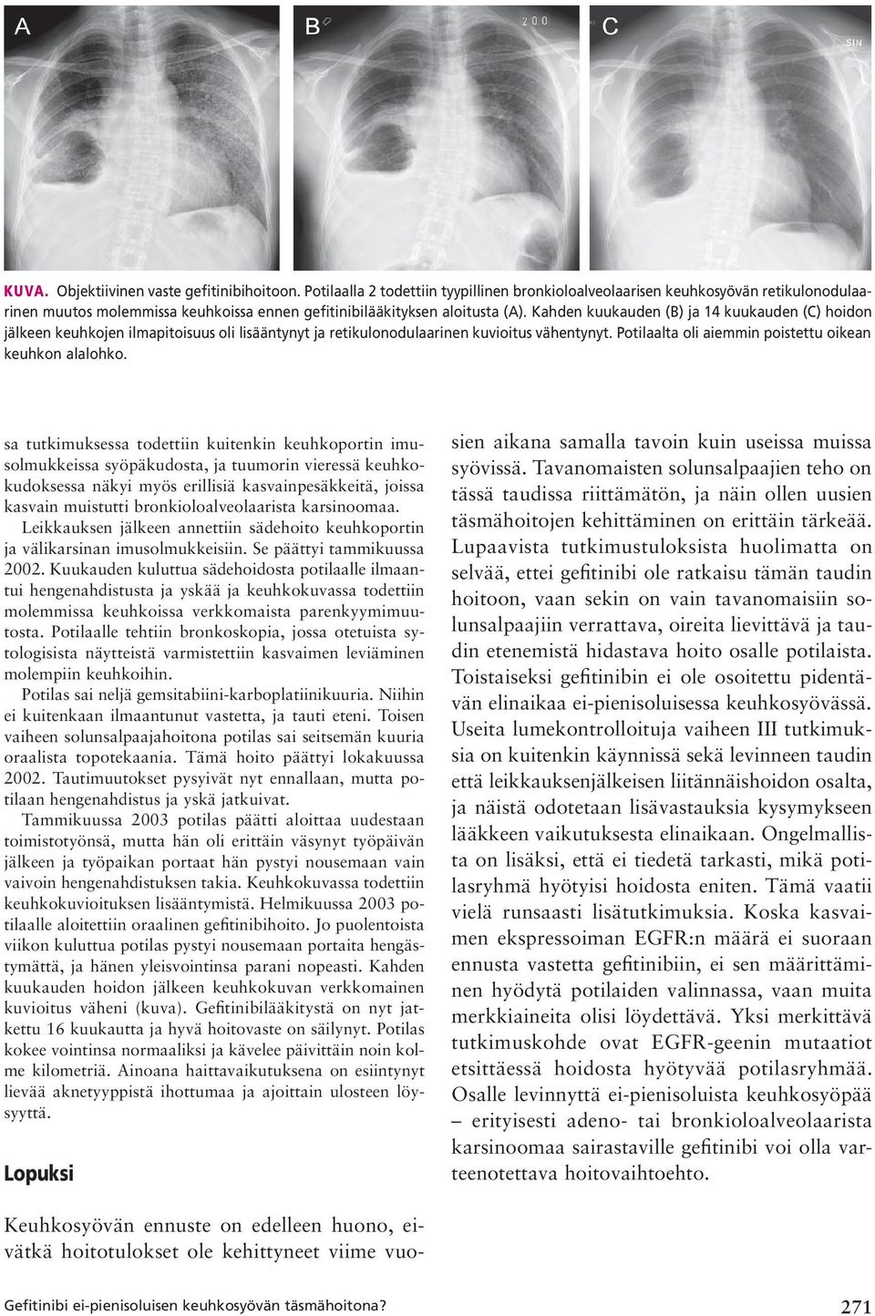 Kahden kuukauden (B) ja 14 kuukauden (C) hoidon jälkeen keuhkojen ilmapitoisuus oli lisääntynyt ja retikulonodulaarinen kuvioitus vähentynyt. Potilaalta oli aiemmin poistettu oikean keuhkon alalohko.