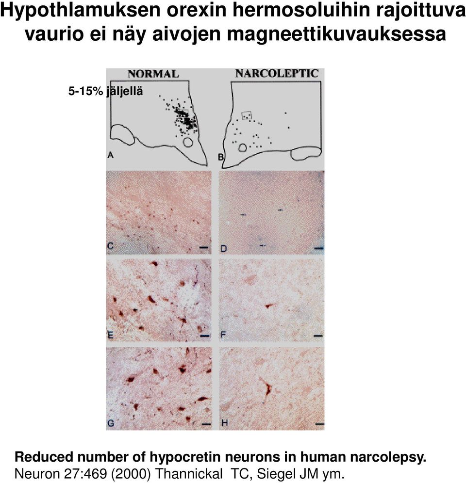 jäljellä Reduced number of hypocretin neurons in