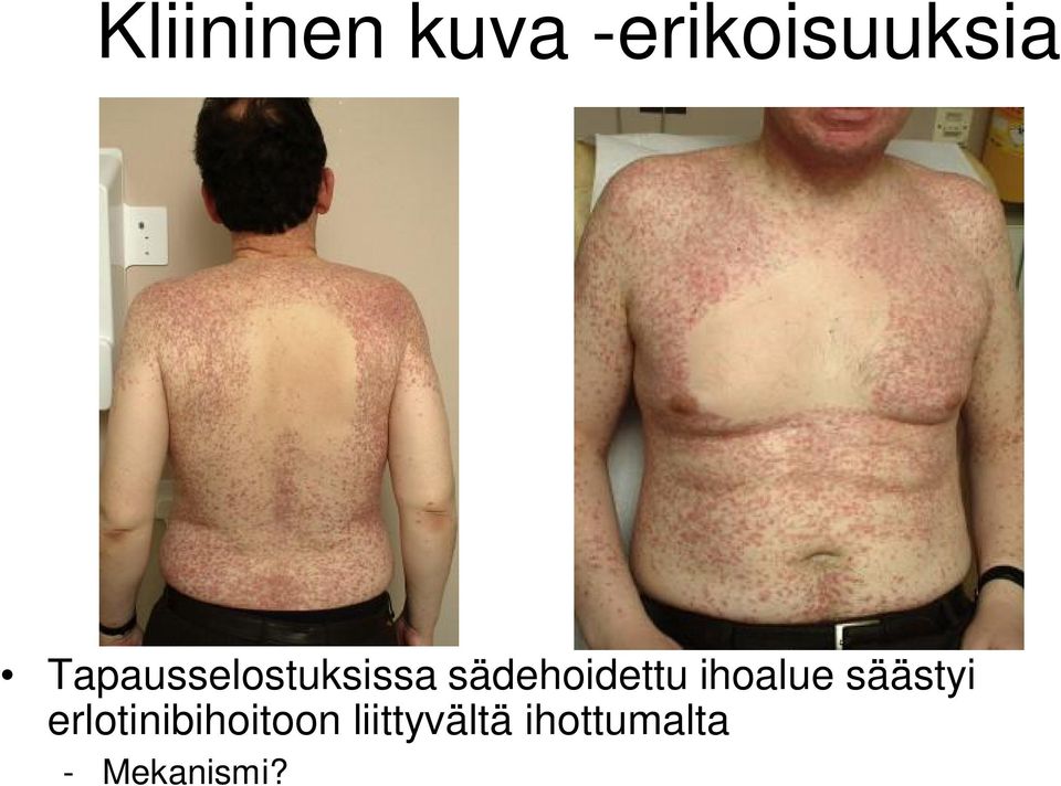 ihoalue säästyi erlotinibihoitoon