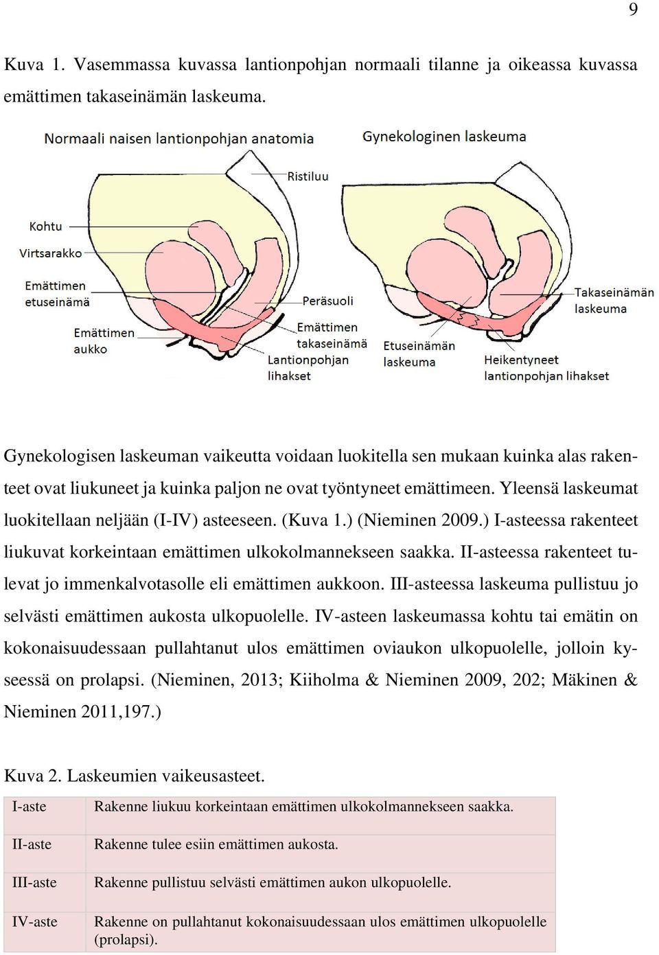 Yleensä laskeumat luokitellaan neljään (I-IV) asteeseen. (Kuva 1.) (Nieminen 2009.) I-asteessa rakenteet liukuvat korkeintaan emättimen ulkokolmannekseen saakka.