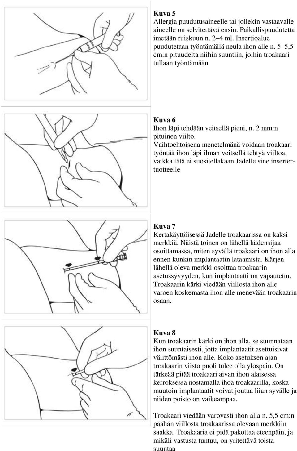 Vaihtoehtoisena menetelmänä voidaan troakaari työntää ihon läpi ilman veitsellä tehtyä viiltoa, vaikka tätä ei suositellakaan Jadelle sine insertertuotteelle Kuva 7 Kertakäyttöisessä Jadelle