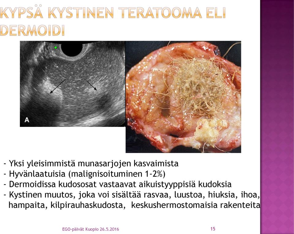 kudoksia - Kystinen muutos, joka voi sisältää rasvaa, luustoa, hiuksia,