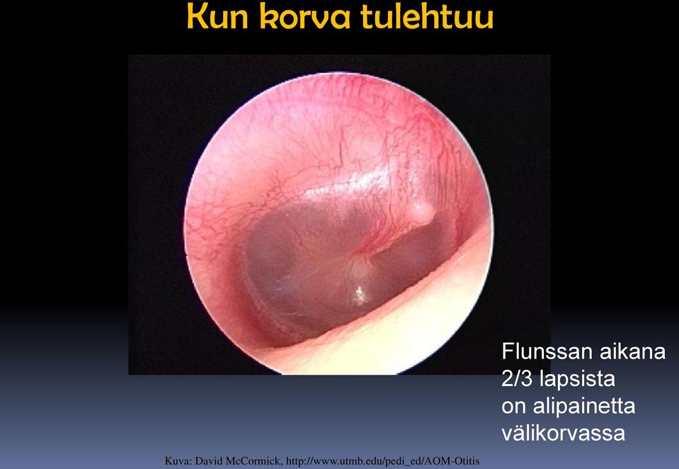 edu/pedi_ed/aom-otitis Flunssan