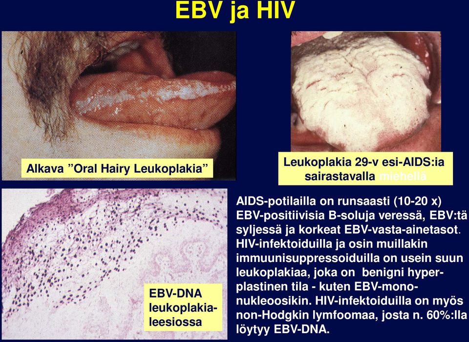 EBV-vasta-ainetasot.