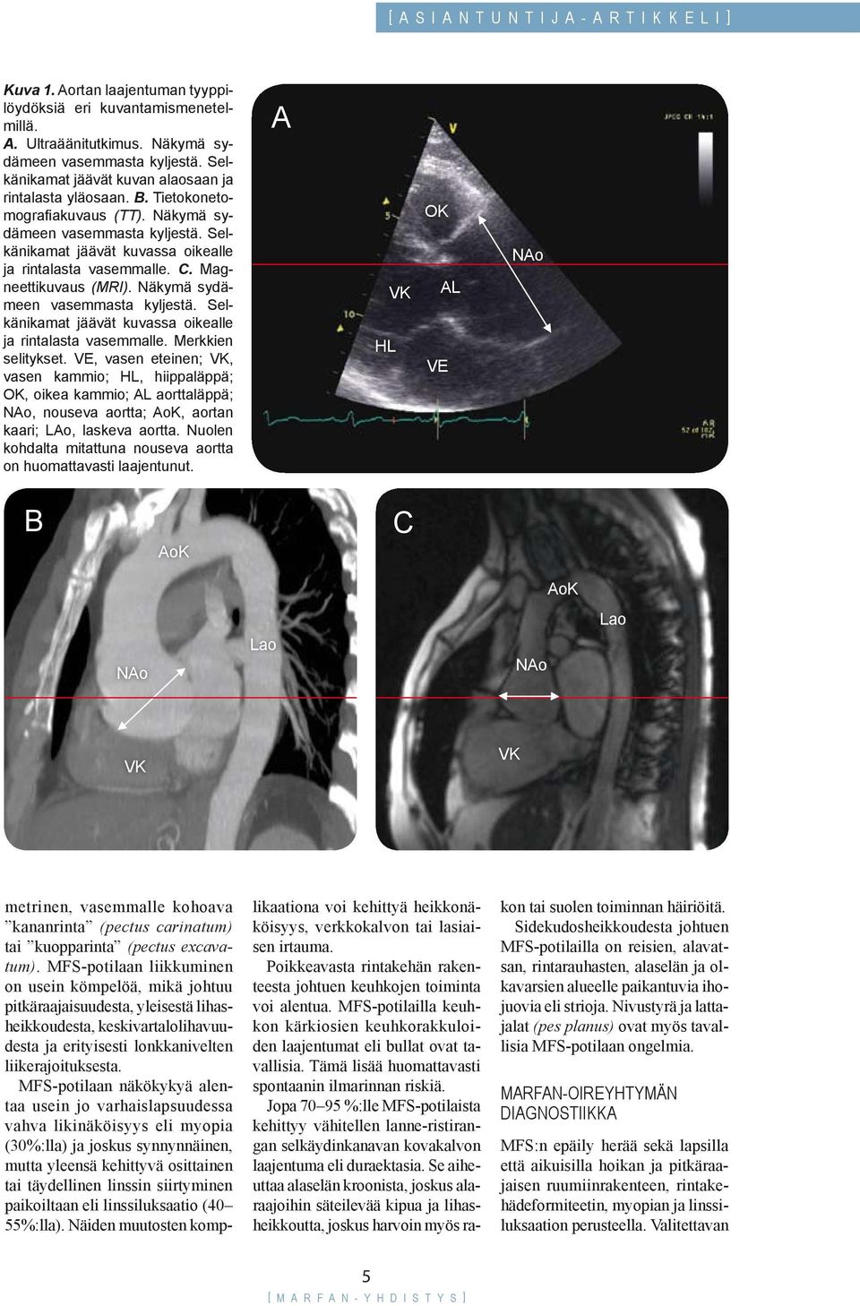 Magneettikuvaus (MRI). Näkymä sydämeen vasemmasta kyljestä. Selkänikamat jäävät kuvassa oikealle ja rintalasta vasemmalle. Merkkien selitykset.