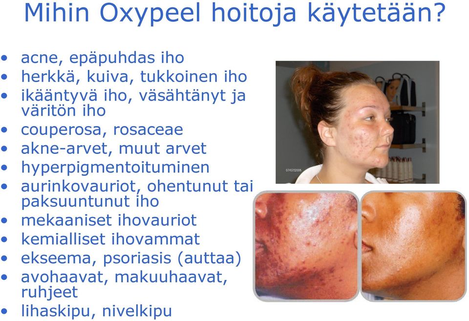 couperosa, rosaceae akne-arvet, muut arvet hyperpigmentoituminen aurinkovauriot,