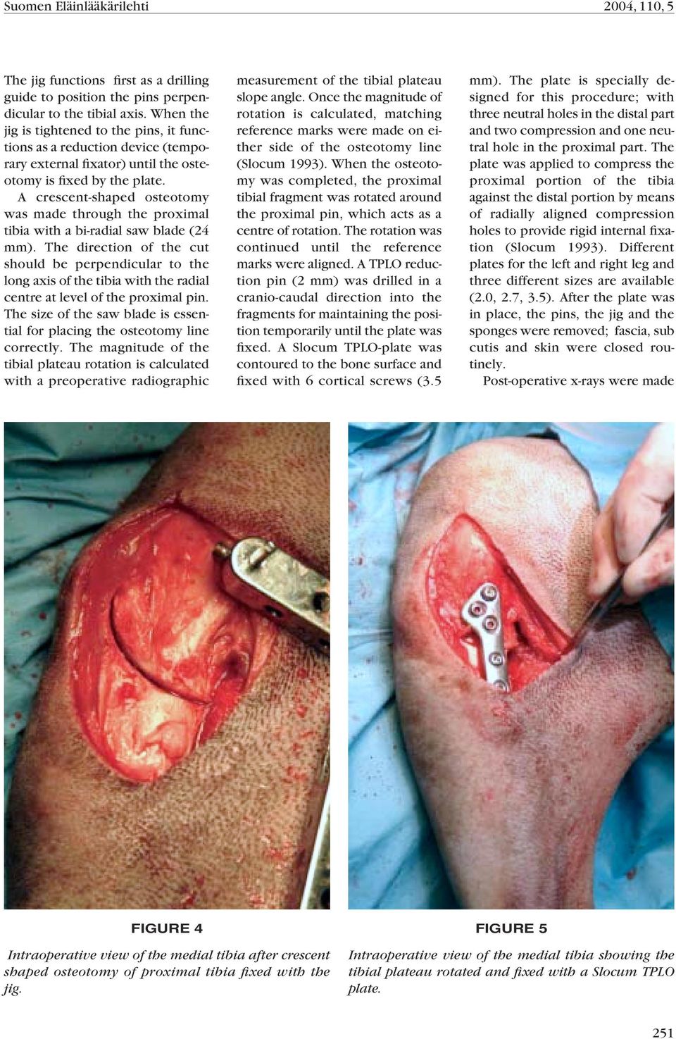 A crescent-shaped osteotomy was made through the proximal tibia with a bi-radial saw blade (24 mm).