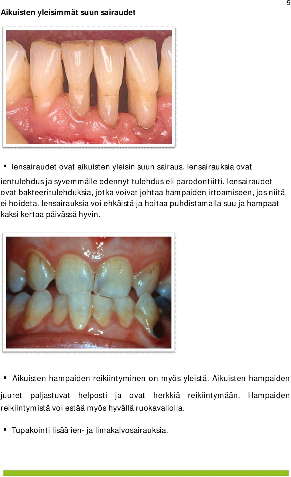 Iensairaudet ovat bakteeritulehduksia, jotka voivat johtaa hampaiden irtoamiseen, jos niitä ei hoideta.