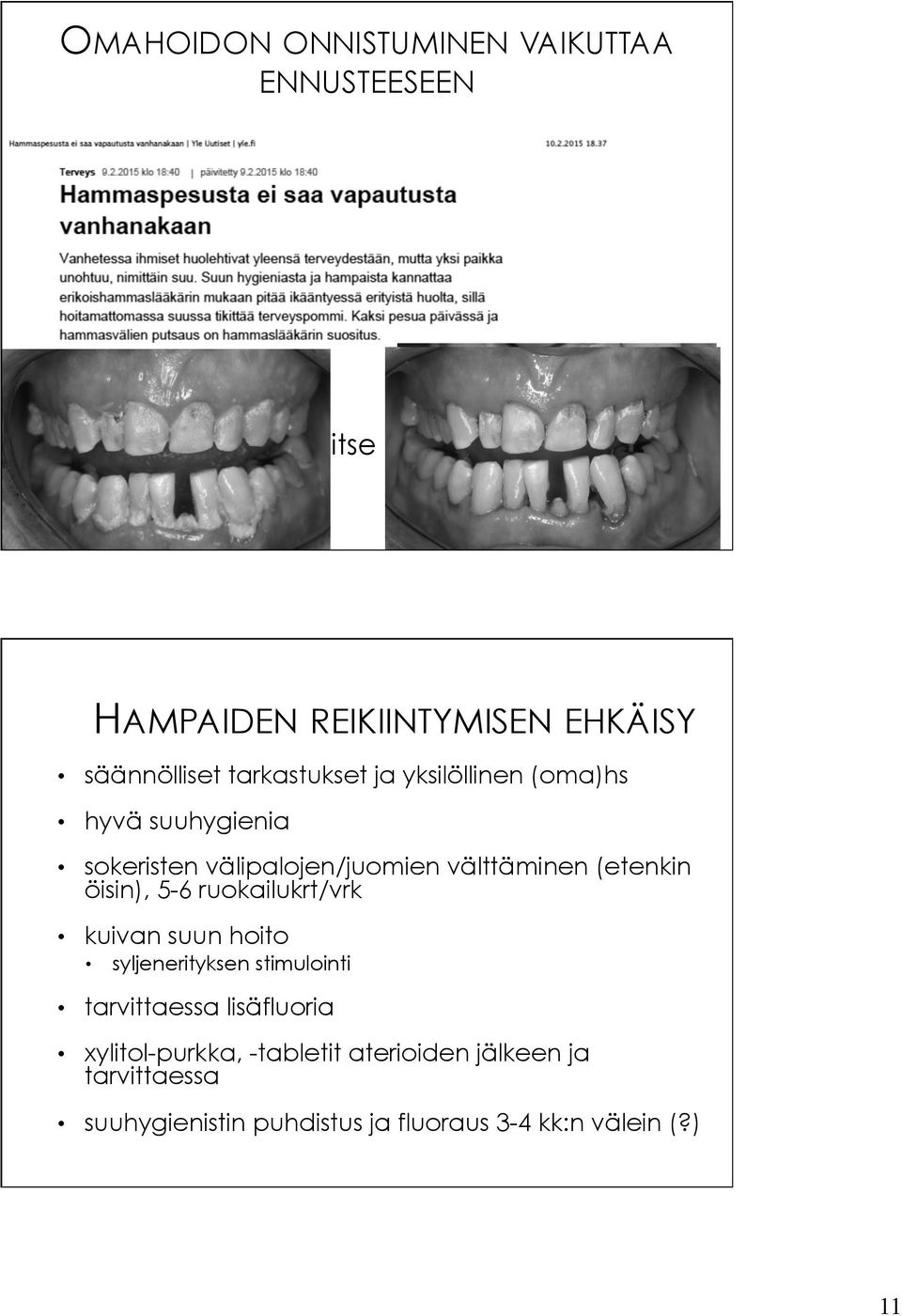 välipalojen/juomien välttäminen (etenkin öisin), 5-6 ruokailukrt/vrk kuivan suun hoito syljenerityksen stimulointi