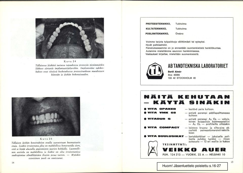 Kuva 24 Tällaisessa jäykästi tuetussa tapauksessa proteesin pienimmätkin liikkeet siirtyvät implantaattipilareihin.