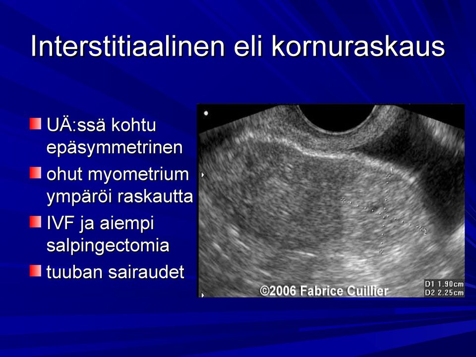 myometrium ympäröi raskautta IVF ja