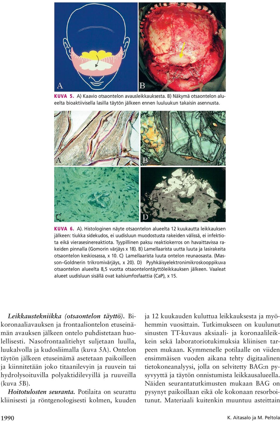 C) Lamellaarista luuta ontelon reunaosasta. (Masson Goldnerin trikromivärjäys, x 20). D) Pyyhkäisyelektronimikroskooppikuva otsaontelon alueelta 8,5 vuotta otsaontelontäyttöleikkauksen jälkeen.