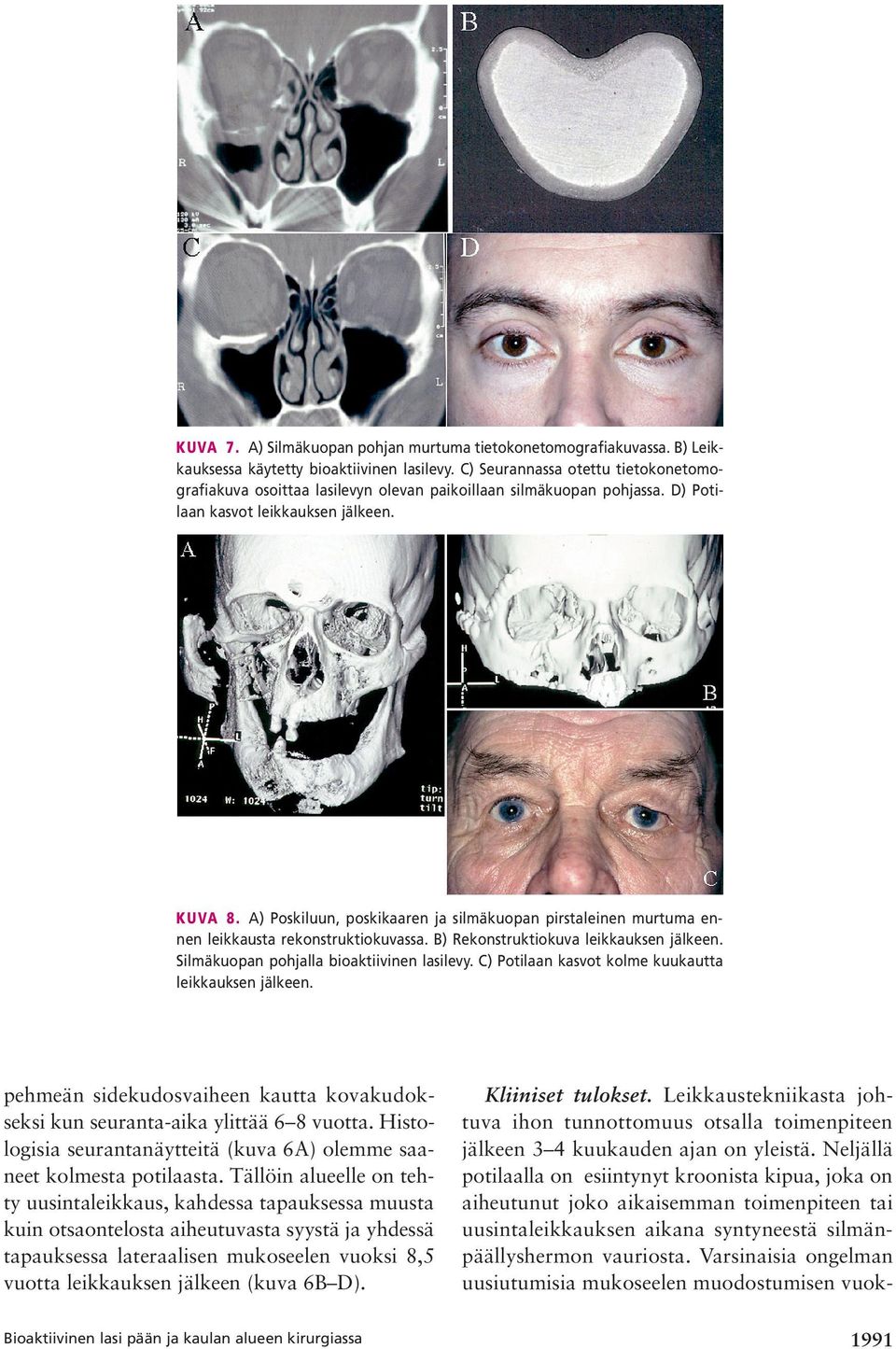 A) Poskiluun, poskikaaren ja silmäkuopan pirstaleinen murtuma ennen leikkausta rekonstruktiokuvassa. B) Rekonstruktiokuva leikkauksen jälkeen. Silmäkuopan pohjalla bioaktiivinen lasilevy.