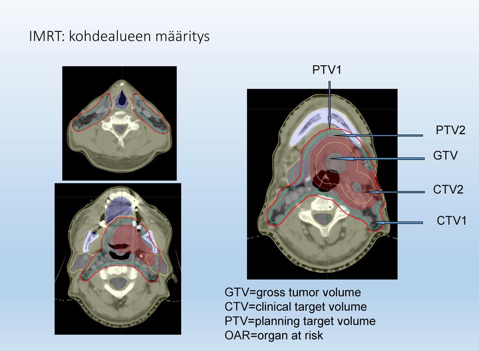 CTV=clinical target volume