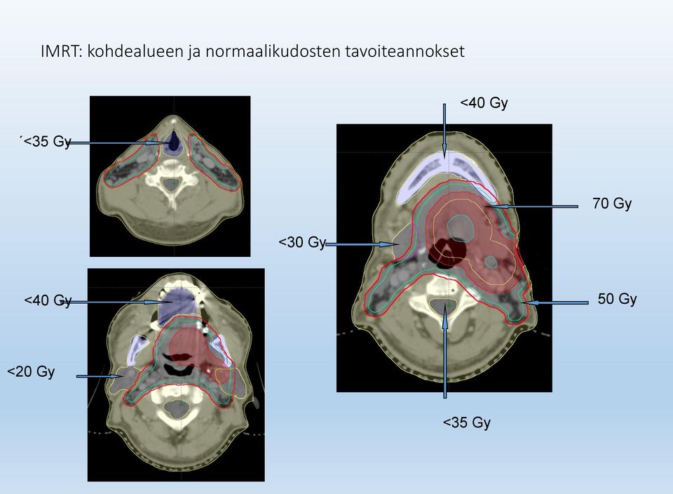 tavoiteannokset <35 Gy <40