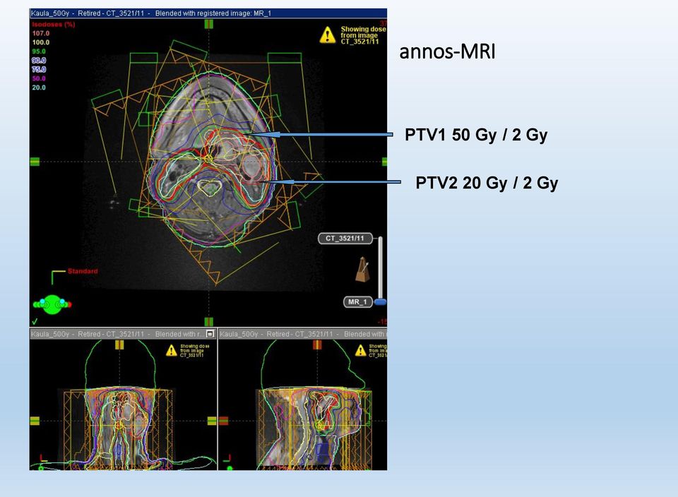 / 2 Gy PTV2