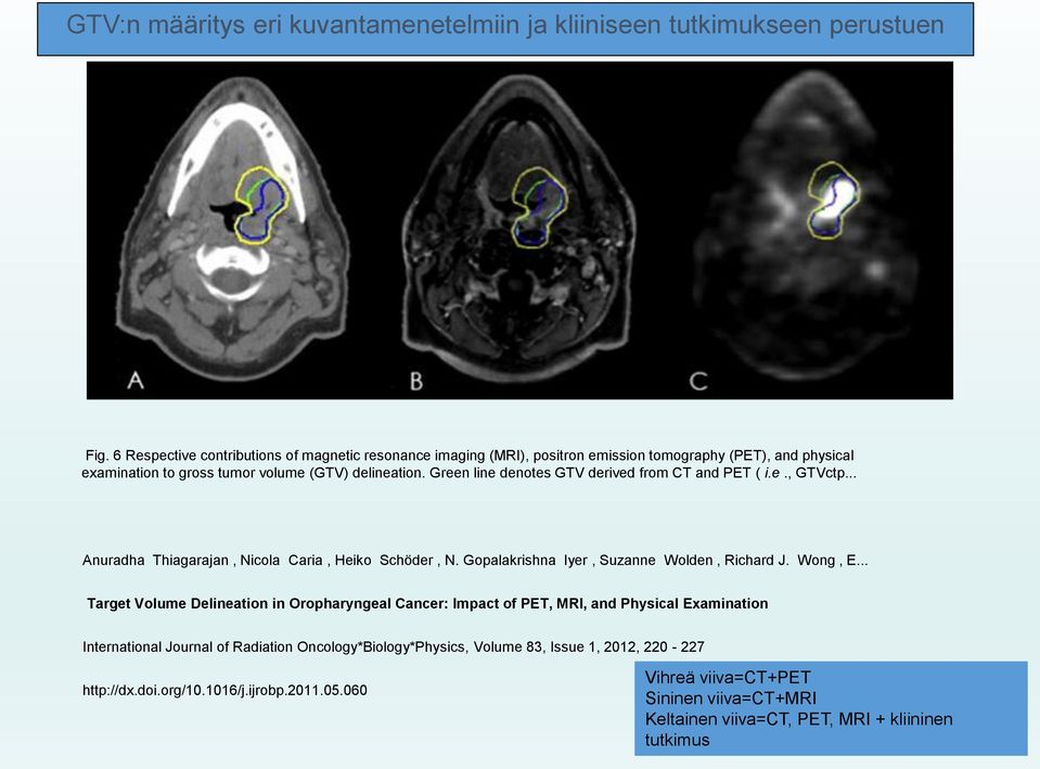 Green line denotes GTV derived from CT and PET ( i.e., GTVctp... Anuradha Thiagarajan, Nicola Caria, Heiko Schöder, N. Gopalakrishna Iyer, Suzanne Wolden, Richard J. Wong, E.