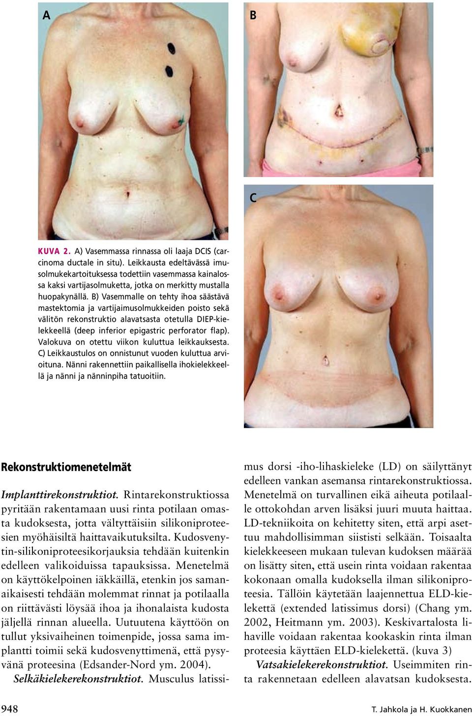 B) Vasemmalle on tehty ihoa säästävä mastektomia ja vartijaimusolmukkeiden poisto sekä välitön rekonstruktio alavatsasta otetulla DIEP-kielekkeellä (deep inferior epigastric perforator flap).