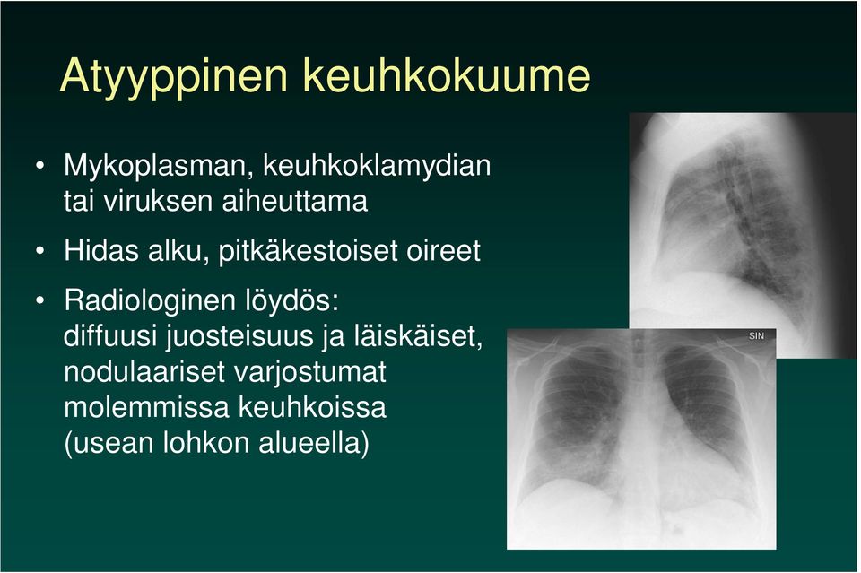 Radiologinen löydös: diffuusi juosteisuus ja läiskäiset,