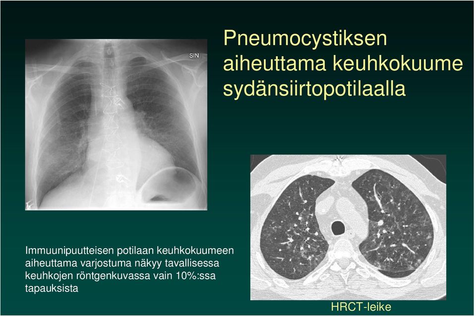 keuhkokuumeen aiheuttama varjostuma näkyy