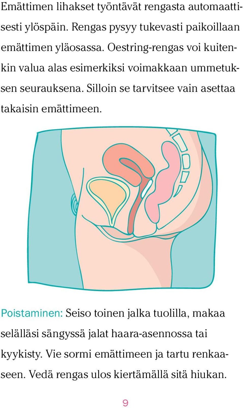 Oestring-rengas voi kuitenkin valua alas esimerkiksi voimakkaan ummetuksen seurauksena.