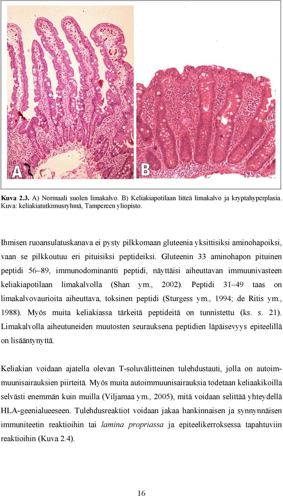 Gluteenin 33 aminohapon pituinen peptidi 56 89, immunodominantti peptidi, näyttäisi aiheuttavan immuunivasteen keliakiapotilaan limakalvolla (Shan ym., 2002).