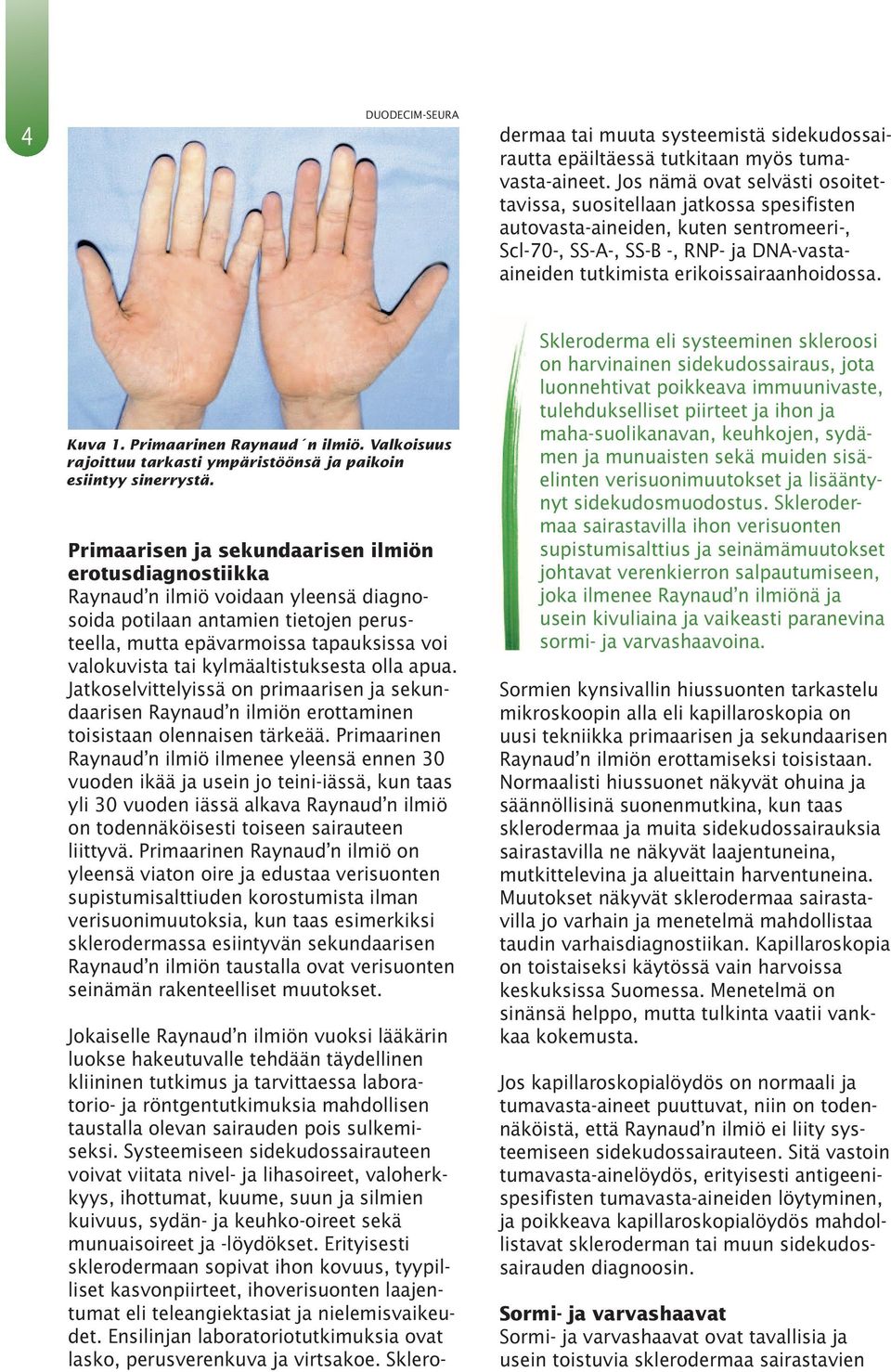Kuva 1. Primaarinen Raynaud n ilmiö. Valkoisuus rajoittuu tarkasti ympäristöönsä ja paikoin esiintyy sinerrystä.