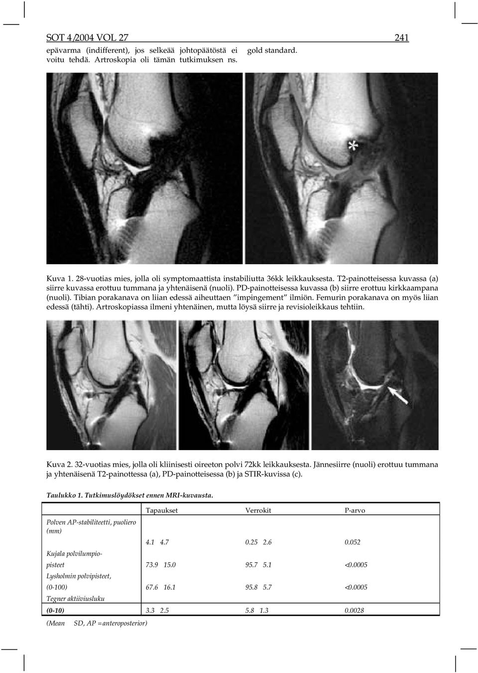 PD-painotteisessa kuvassa (b) siirre erottuu kirkkaampana (nuoli). Tibian porakanava on liian edessä aiheuttaen impingement ilmiön. Femurin porakanava on myös liian edessä (tähti).