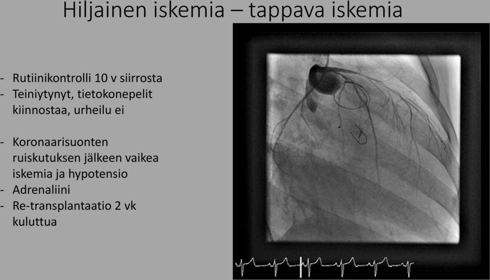 ei - Koronaarisuonten ruiskutuksen jälkeen vaikea iskemia