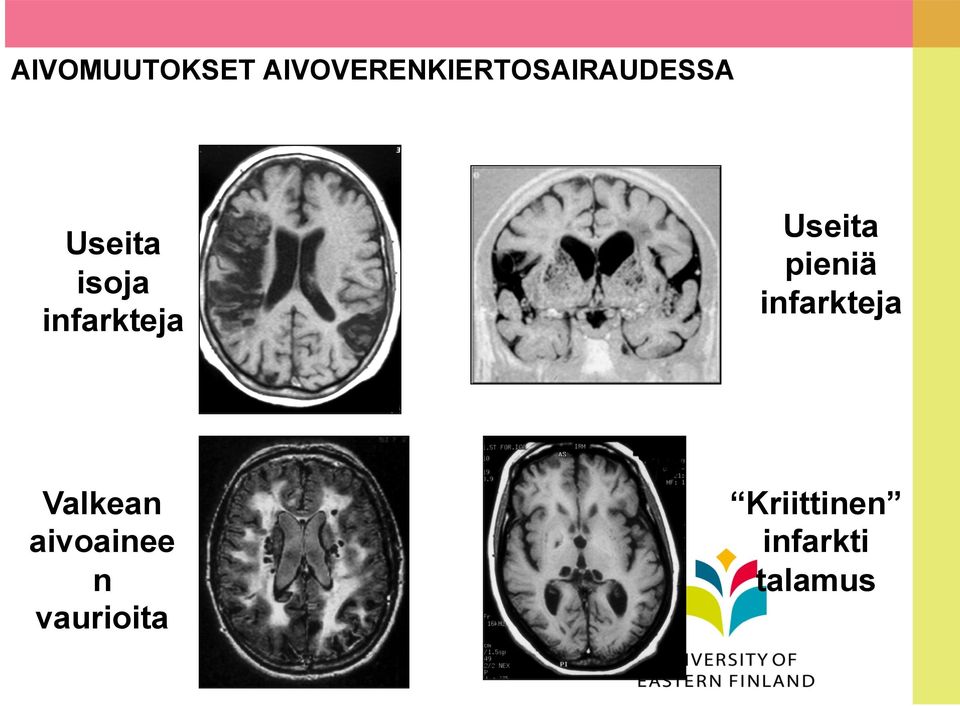 isoja infarkteja Useita pieniä