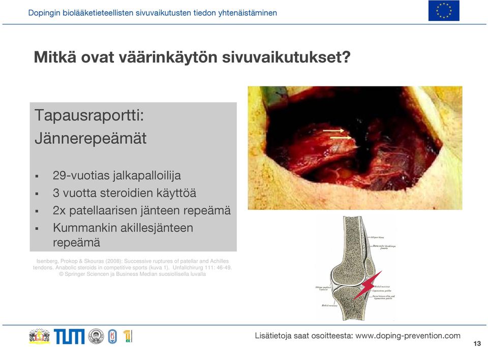 jänteen repeämä Kummankin akillesjänteen repeämä Isenberg, Prokop & Skouras (2008): Successive ruptures