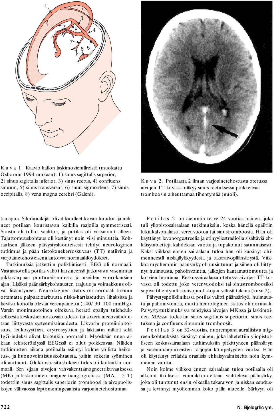 sigmoideus, 7) sinus occipitalis, 8) vena magna cerebri (Galeni). K u v a 2.