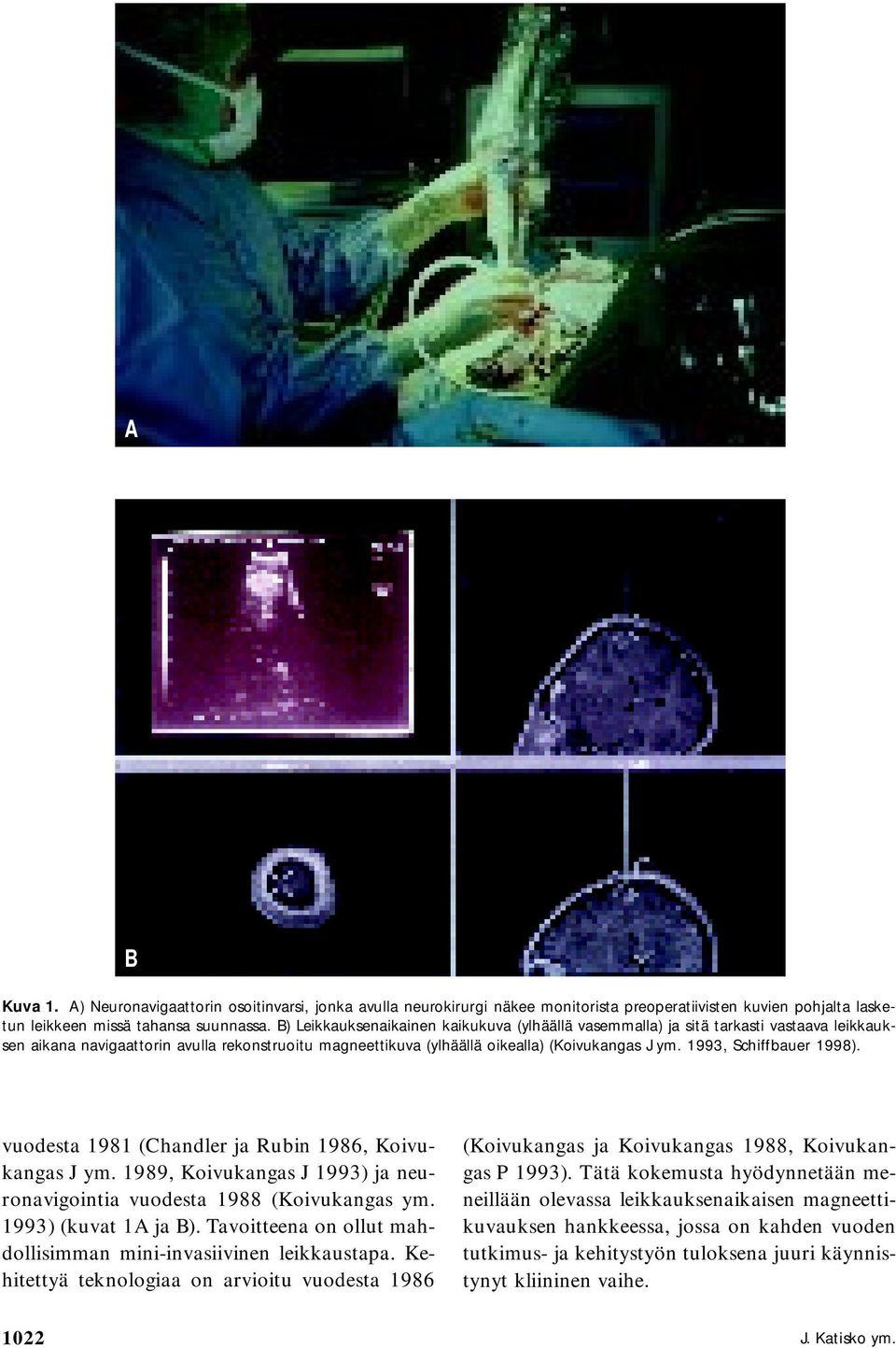 1993, Schiffbauer 1998). vuodesta 1981 (Chandler ja Rubin 1986, Koivukangas J ym. 1989, Koivukangas J 1993) ja neuronavigointia vuodesta 1988 (Koivukangas ym. 1993) (kuvat 1A ja B).