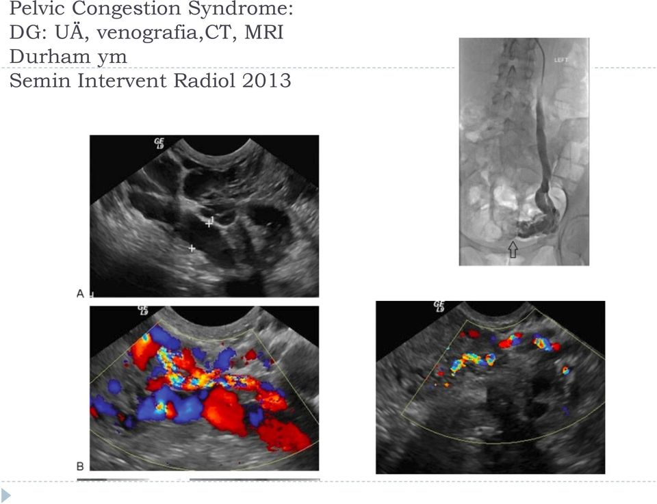 venografia,ct, MRI