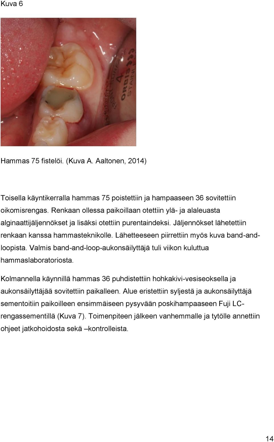 Lähetteeseen piirrettiin myös kuva band-andloopista. Valmis band-and-loop-aukonsäilyttäjä tuli viikon kuluttua hammaslaboratoriosta.