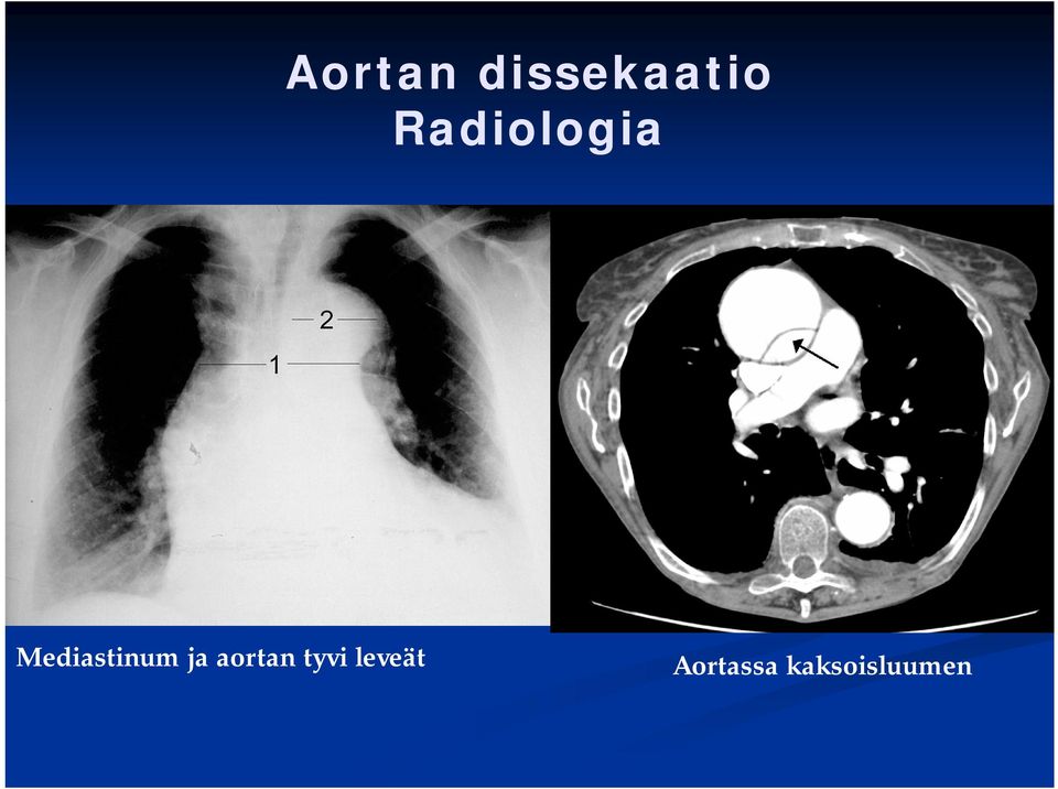 Mediastinum ja aortan