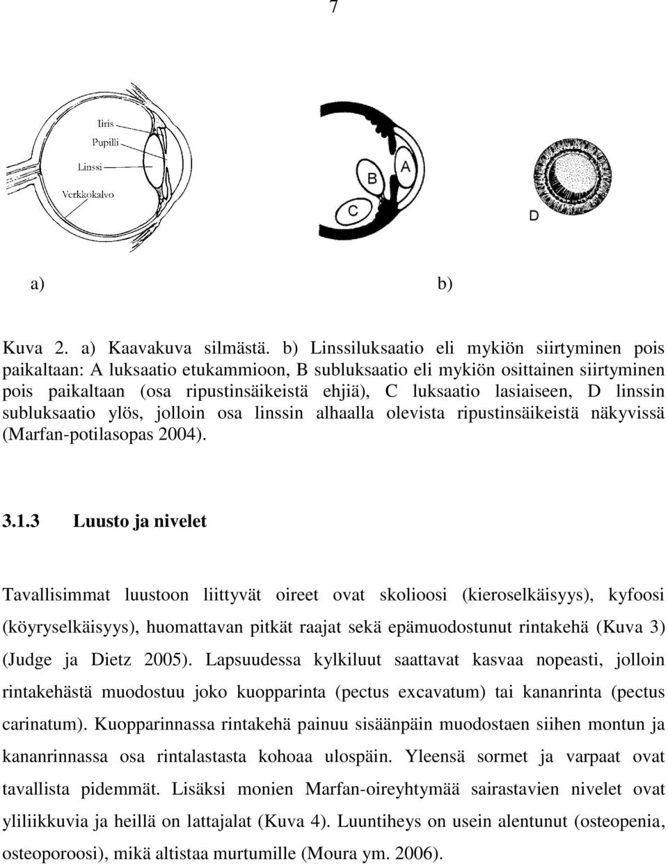 lasiaiseen, D linssin subluksaatio ylös, jolloin osa linssin alhaalla olevista ripustinsäikeistä näkyvissä (Marfan-potilasopas 2004). 3.1.