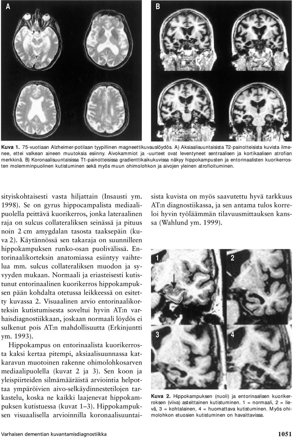 B) Koronaalisuuntaisissa T1-painotteisissa gradienttikaikukuvissa näkyy hippokampusten ja entorinaalisten kuorikerrosten molemminpuolinen kutistuminen sekä myös muun ohimolohkon ja aivojen yleinen