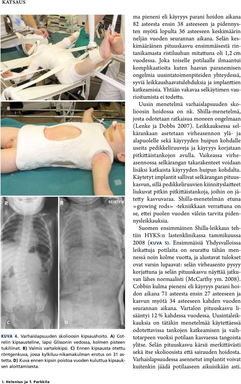 D ma pieneni eli käyryys parani hoidon aikana 2 asteesta ensin 3 asteeseen ja pidennysten myötä lopulta 36 asteeseen keskimäärin neljän vuoden seurannan aikana.