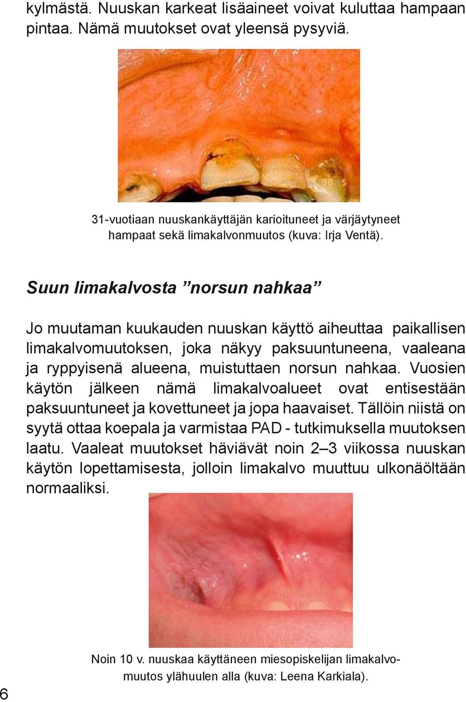 Suun limakalvosta norsun nahkaa Jo muutaman kuukauden nuuskan käyttö aiheuttaa paikallisen limakalvomuutoksen, joka näkyy paksuuntuneena, vaaleana ja ryppyisenä alueena, muistuttaen norsun nahkaa.