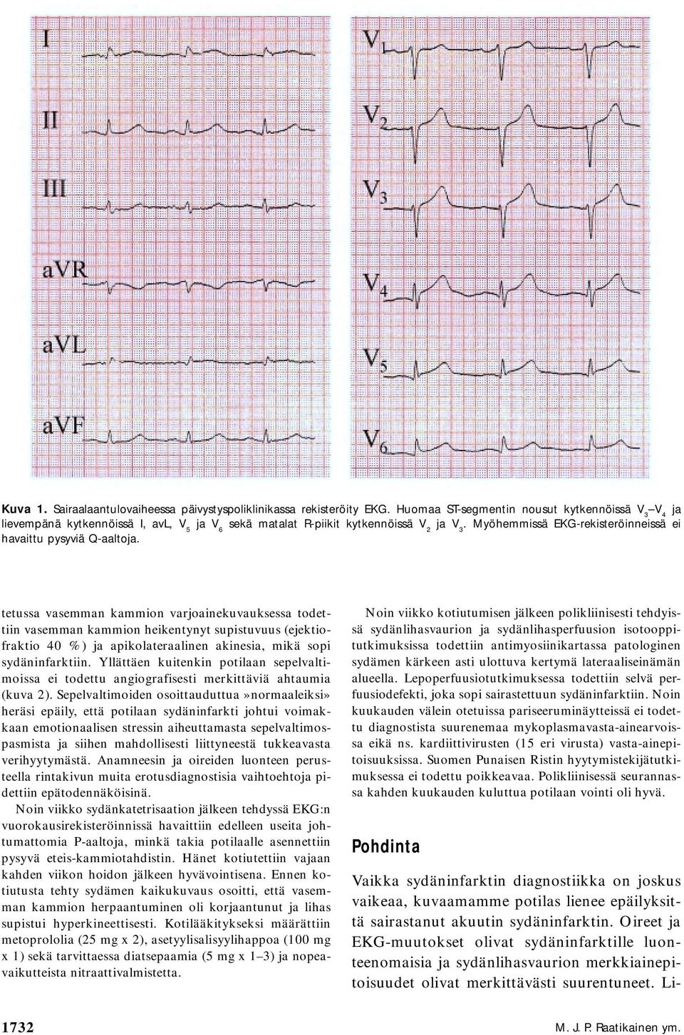 Myöhemmissä EKG-rekisteröinneissä ei havaittu pysyviä Q-aaltoja.