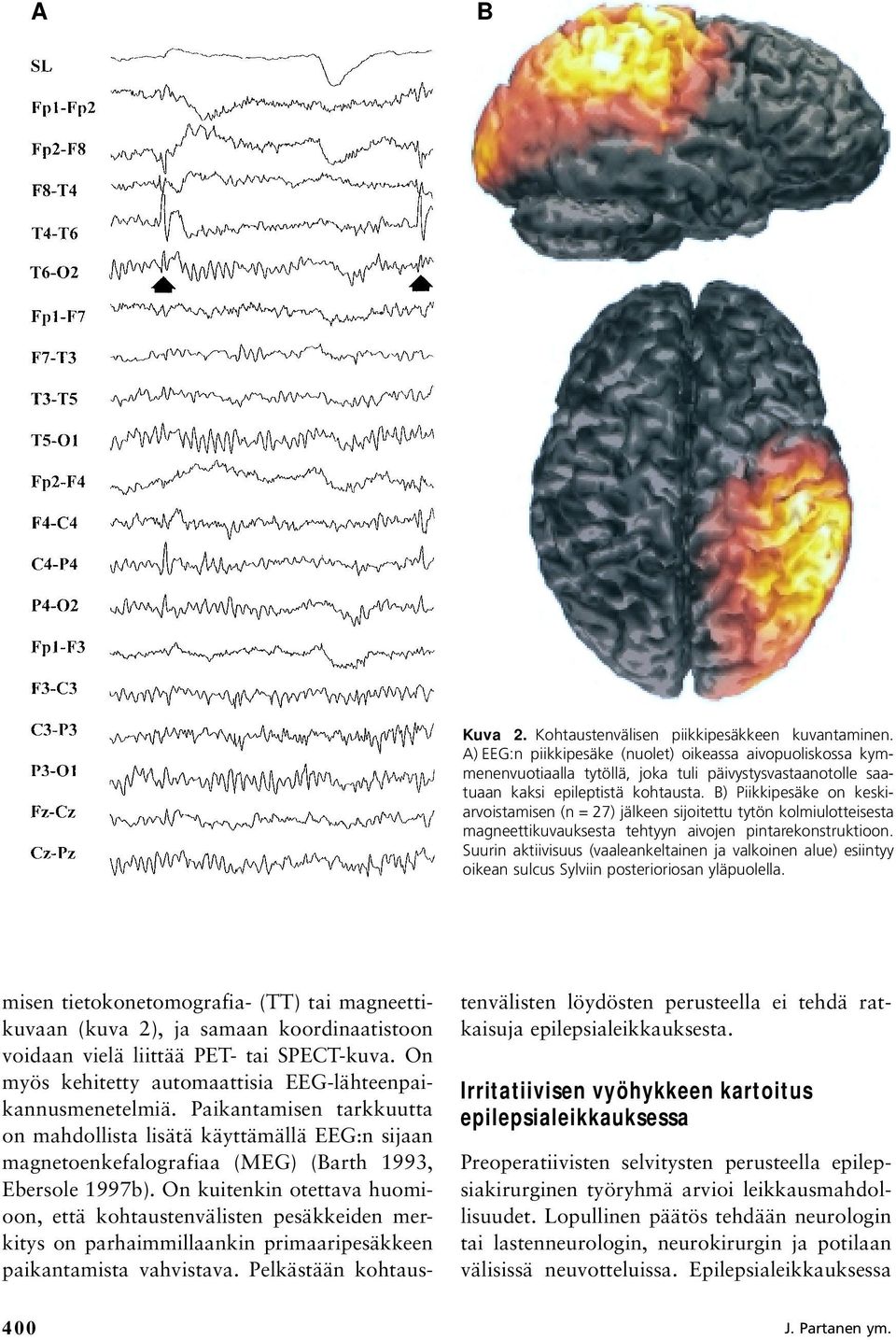 B) Piikkipesäke on keskiarvoistamisen (n = 27) jälkeen sijoitettu tytön kolmiulotteisesta magneettikuvauksesta tehtyyn aivojen pintarekonstruktioon.