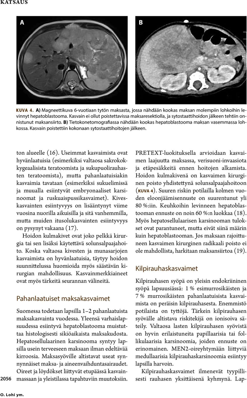 Kasvain poistettiin kokonaan sytostaattihoitojen jälkeen. 2056 ton alueelle (16).