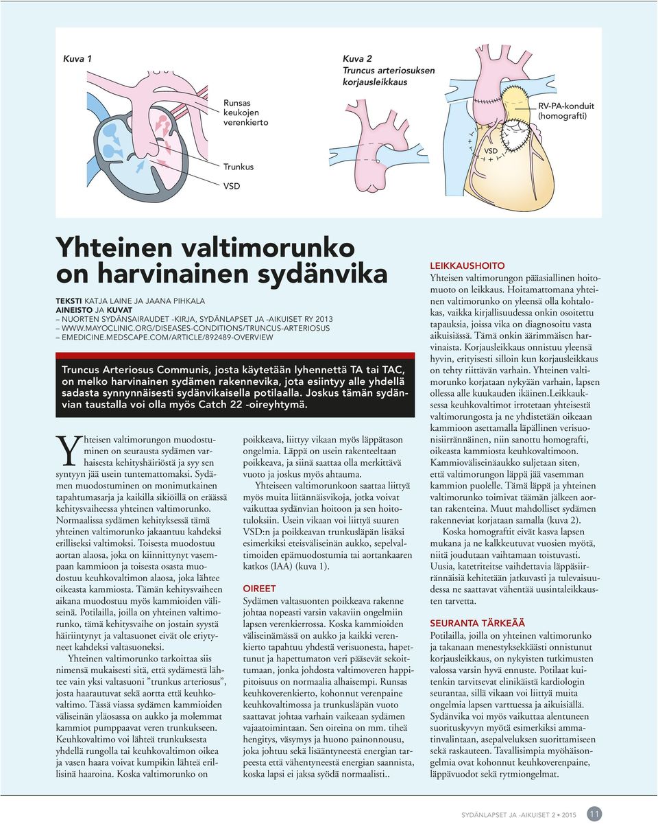 COM/ARTICLE/892489-OVERVIEW Truncus Arteriosus Communis, josta käytetään lyhennettä TA tai TAC, on melko harvinainen sydämen rakennevika, jota esiintyy alle yhdellä sadasta synnynnäisesti