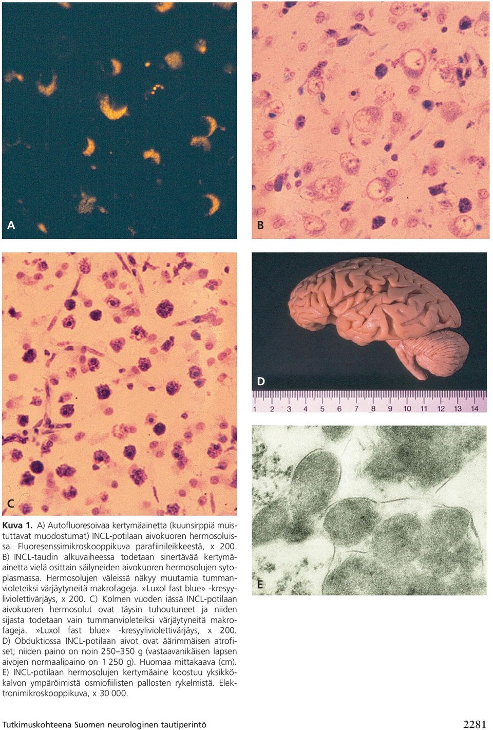 Hermosolujen väleissä näkyy muutamia tummanvioleteiksi värjäytyneitä makrofageja.»luxol fast blue» -kresyyliviolettivärjäys, x 200.