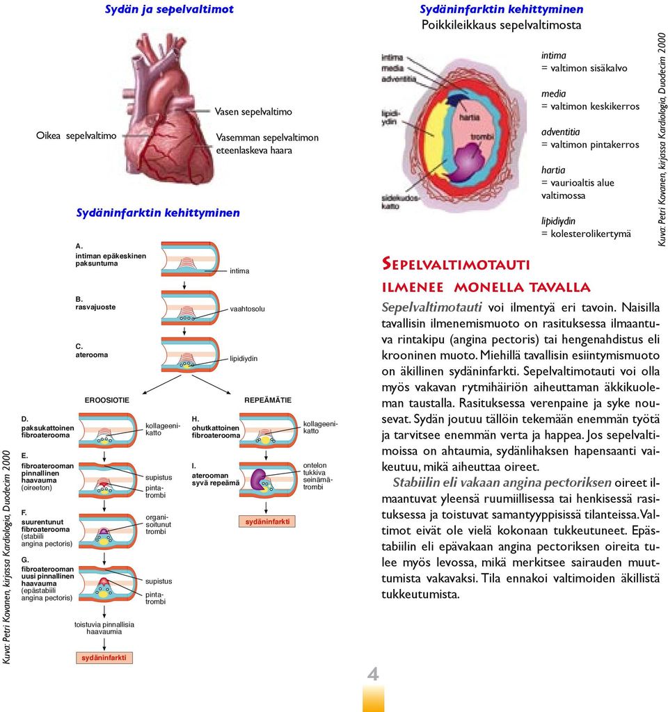 aterooma EROOSIOTIE toistuvia pinnallisia haavaumia sydäninfarkti Sydän ja sepelvaltimot Sydäninfarktin kehittyminen supistus pintatrombi ontelon tukkiva seinämätrombi organisoitunut trombi supistus