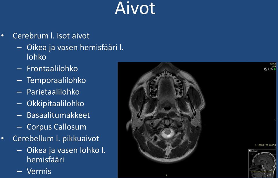 Okkipitaalilohko Basaalitumakkeet Corpus Callosum